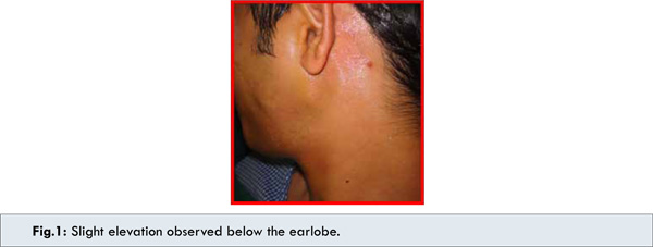 pleomorphic adenoma treatment parotid