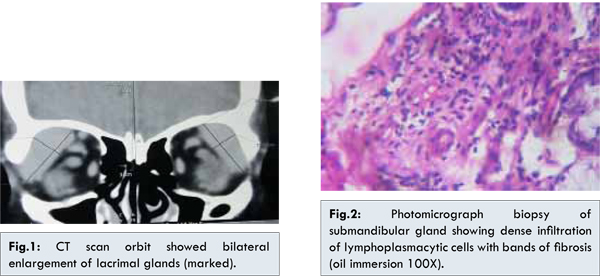 IgG4-related disease | Genetic and Rare Diseases ...