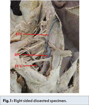 A Rare Case Of Bilateral Jugular Venous Malformation