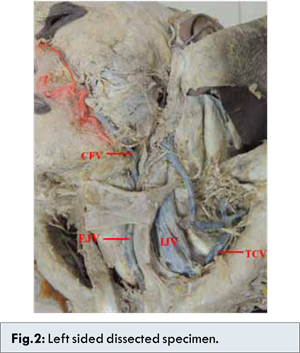 A Rare Case Of Bilateral Jugular Venous Malformation