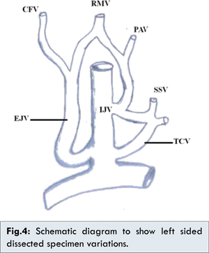 A Rare Case Of Bilateral Jugular Venous Malformation