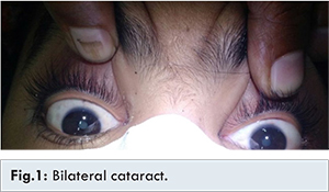 Bilateral Cataract: Unusual Manifestation of Type 1 Diabetes Mellitus