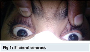 cataract diabetes mellitus 2-kezelés