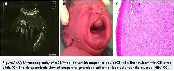 A Congenital Epulis Case: A Rare Entity Diagnosed Perinatally