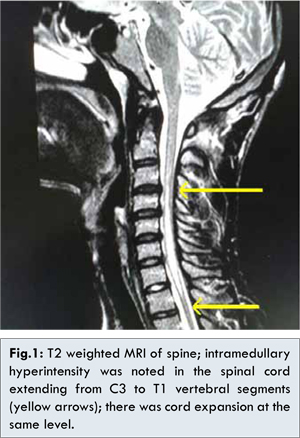 What is viral myelitis?