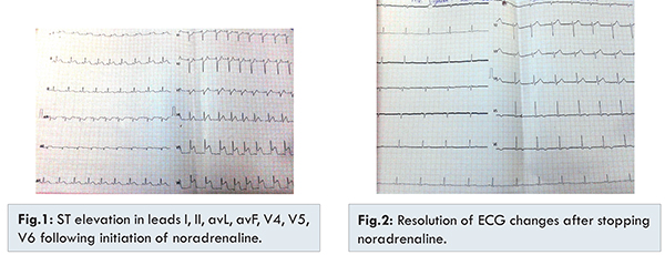 Allergy Induced Myocardial Infarction - Kounis Syndrome / Coronary  Hypersensitivity Disorder / Vasospastic Angina