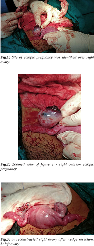 Primary Ovarian Ectopic Pregnancy