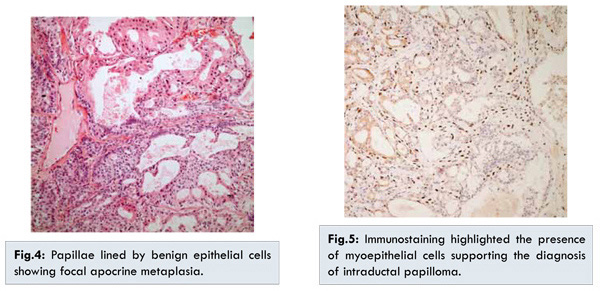 intraductalis papilloma vs csatorna ectasia