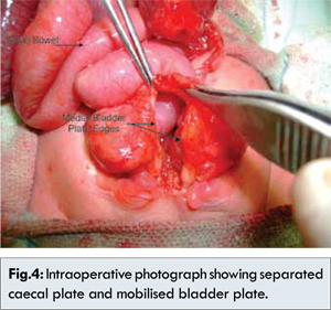Pregnancy and imperforate anus