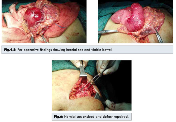 Muscle hernia in a 40-year-old man with a tender palpable mass at