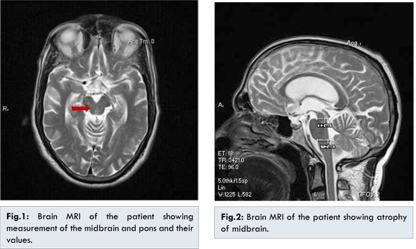 Mareo Definitivo Sombreado Parkinson's Disease and Early Stages of Progressive Supranuclear Palsy: A  Neurological Mimicry