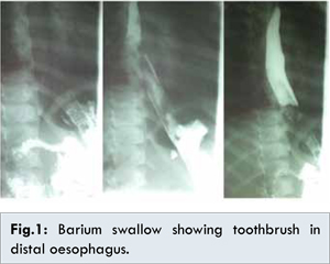 Nil Per Oral 85